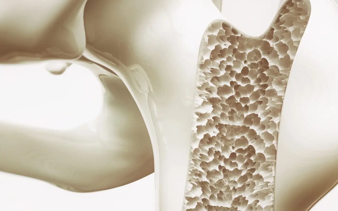 Le nuove cure per l’osteoporosi avanzata: tutto quello che c’è da sapere