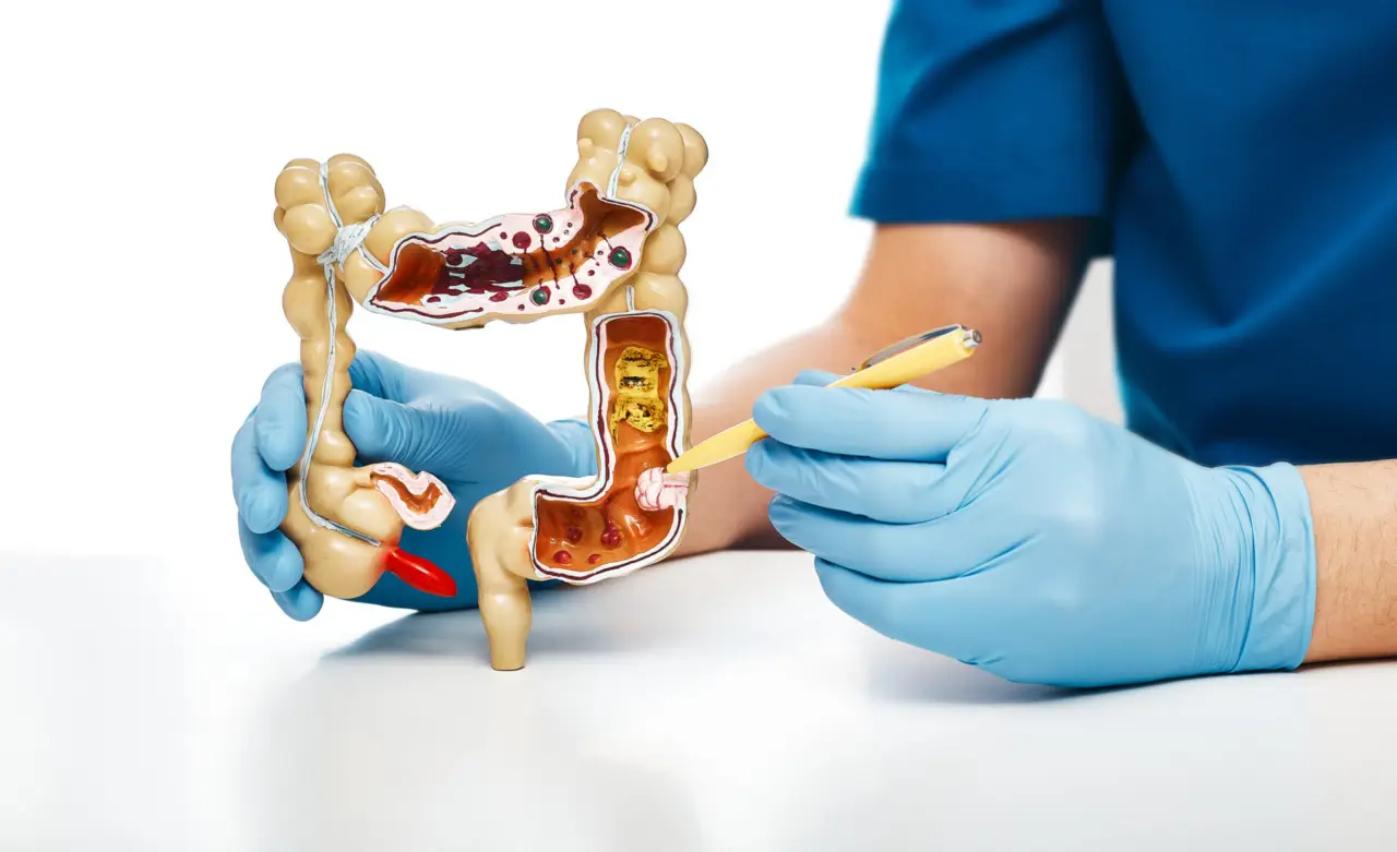 Attenzione se hai questa età: è il momento critico in cui si manifesta il morbo di Crohn