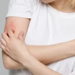 Orticaria da stress: come riconoscere dove si localizza