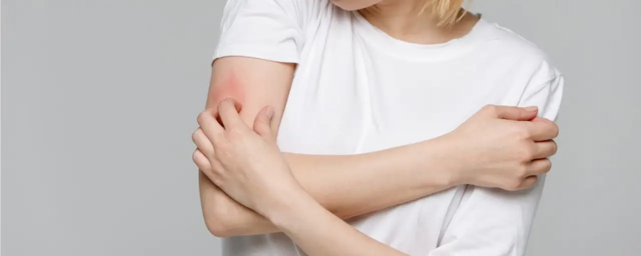 Orticaria da stress: come riconoscere dove si localizza